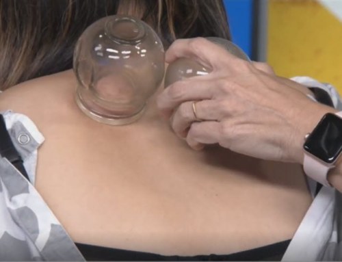 Trying Out the Fitness Trend – Cupping